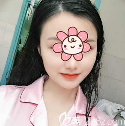 國內(nèi)人中縮短術(shù)哪里做得好？分享我在深圳潤澤瑞尼絲找陳敬武做的人中縮短術(shù)案例效果給大家