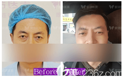 張金娥祛眼袋怎么樣？北京紫潔不開刀祛眼袋案例詮釋實(shí)力