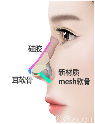 韓國純真mesh材料隆鼻示意圖