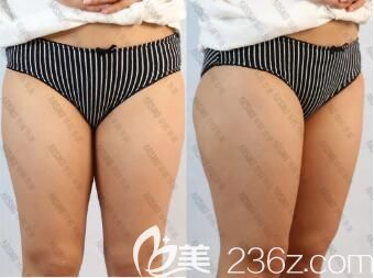 做吸脂瘦大腿術(shù)前照 做吸脂瘦大腿術(shù)前照