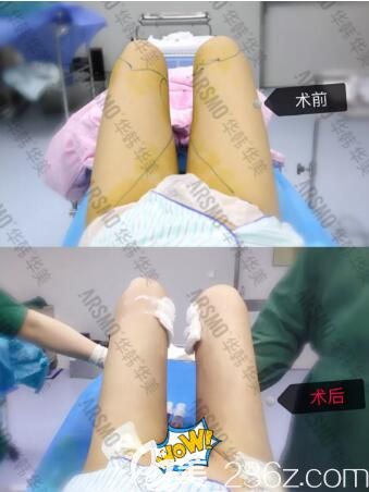 在長(zhǎng)沙華韓華美做大腿吸脂術(shù)前術(shù)后即刻效果對(duì)比照 在長(zhǎng)沙華韓華美做大腿吸脂術(shù)前術(shù)后即刻效果對(duì)比照