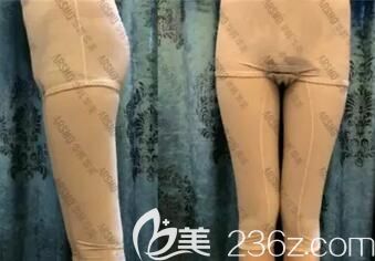 在華韓華美做大腿吸脂術(shù)后10天效果 在華韓華美做大腿吸脂術(shù)后10天效果