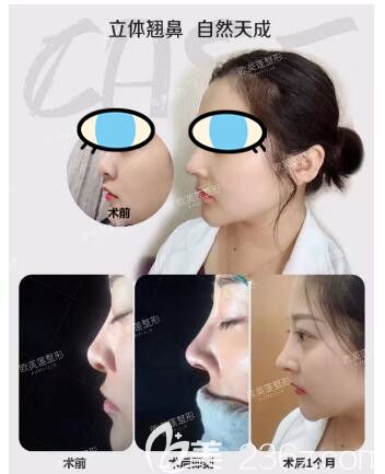 太原歐美蓮整形醫(yī)院姚冰鼻綜合案例