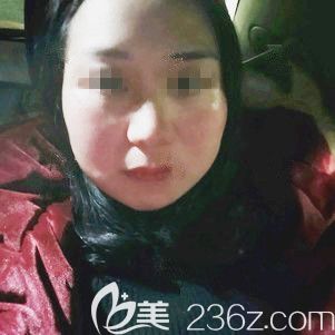 剛做完激光祛雀斑臉上有輕微紅腫 剛做完激光祛雀斑臉上有輕微紅腫