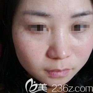 激光祛雀斑第二天恢復中 激光祛雀斑第二天恢復中