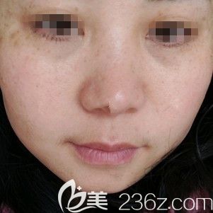 祛雀斑術后五天開始結痂 祛雀斑術后五天開始結痂