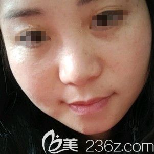 一周后激光祛雀斑恢復情況 一周后激光祛雀斑恢復情況