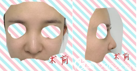 我在德州做玻尿酸隆鼻的術(shù)前照片 我在德州做玻尿酸隆鼻的術(shù)前照片