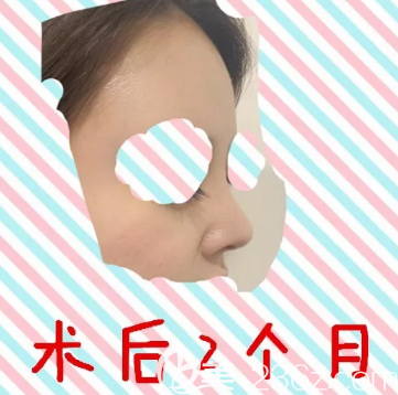 玻尿酸隆鼻術(shù)后即刻照片 玻尿酸隆鼻術(shù)后即刻照片