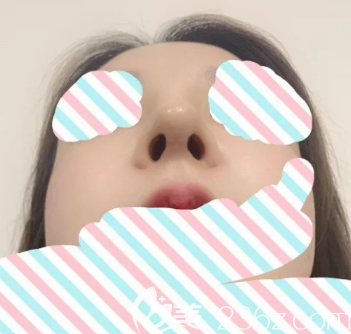 德州玻尿酸隆鼻后鼻尖的形態(tài) 德州玻尿酸隆鼻后鼻尖的形態(tài)