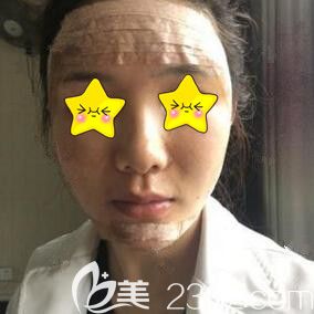 自體脂肪填充全臉術(shù)后第1天