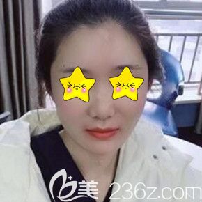 做自體脂肪填充面部術(shù)后一周恢復(fù)效果