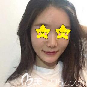 在長沙臉博士做自體脂肪填充面部術(shù)后20天恢復(fù)效果圖