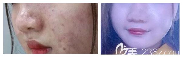 查錦東做激光祛痘案例效果對比圖