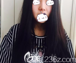 我在德州做鼻綜合的術(shù)前照片 我在德州做鼻綜合的術(shù)前照片