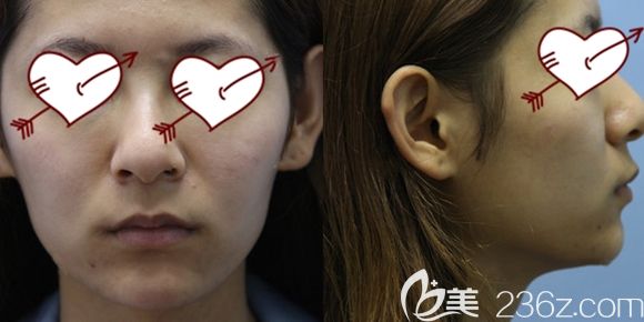 長春中妍整形自體脂肪面部填充術(shù)前照 長春中妍整形自體脂肪面部填充術(shù)前照