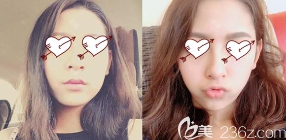 長春中妍整形做面部脂肪移植術(shù)后一周效果圖 長春中妍整形做面部脂肪移植術(shù)后一周效果圖