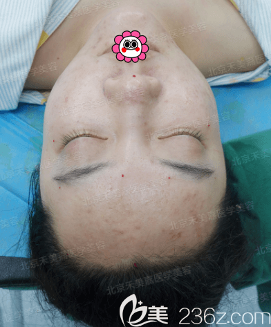 任學(xué)會(huì)醫(yī)生準(zhǔn)備給我做面部脂肪加減法手術(shù)當(dāng)天照