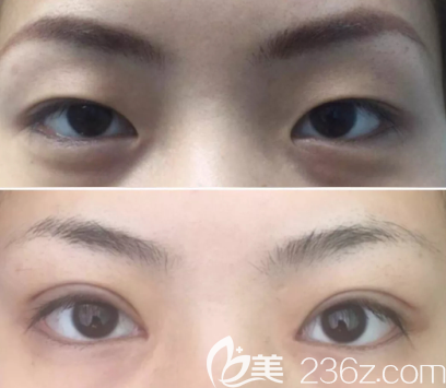 湖南省<!--<i data=20240703-sp></i>--><!--<i data=20240703-sp></i>-->醫(yī)生做的雙眼皮案例