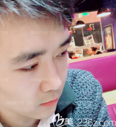 北京華韓雙眼皮修復(fù)怎么樣？我在北京華韓做日式全切雙眼皮第7天效果參考