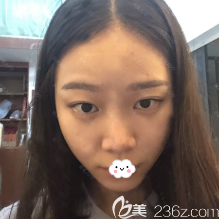 廣州韓妃醫(yī)學整形美容門診部牟北平術前照片1