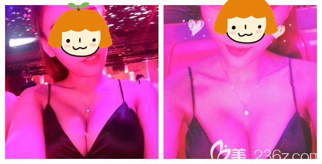 術(shù)后兩個月假體隆胸恢復情況