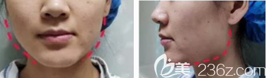 德州做切除下頜角+顴骨手術(shù)的術(shù)前照片 德州做切除下頜角+顴骨手術(shù)的術(shù)前照片