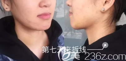 在德州做下頜角+顴骨術(shù)后第7天的樣子 在德州做下頜角+顴骨術(shù)后第7天的樣子