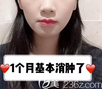 德州做下頜角+顴骨手術(shù)術(shù)后一個月 德州做下頜角+顴骨手術(shù)術(shù)后一個月