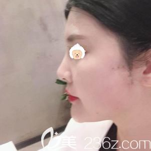 做玻尿酸豐蘋果肌術后15天腫脹消除 做玻尿酸豐蘋果肌術后15天腫脹消除