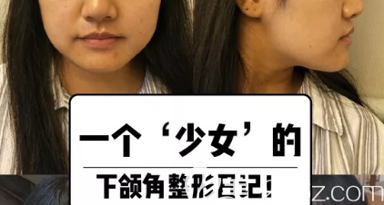 磨骨術(shù)前照片