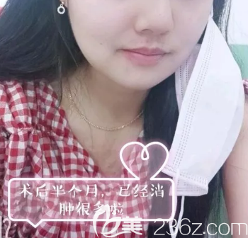 磨骨術(shù)后半個(gè)月照片