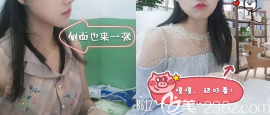 磨骨術(shù)后一年的照片