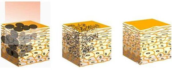 激光祛斑多久可以恢復呢？