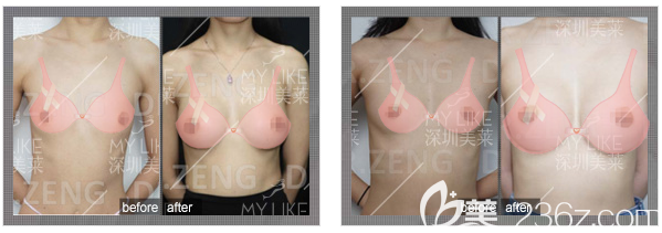 <!--<i data=20240703-sp></i>-->曾昂假體隆胸實(shí)例對(duì)比圖