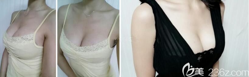 在韓國DA整形具賢國那做了水滴隆胸，效果真的好好再也沒人叫我太平公主了