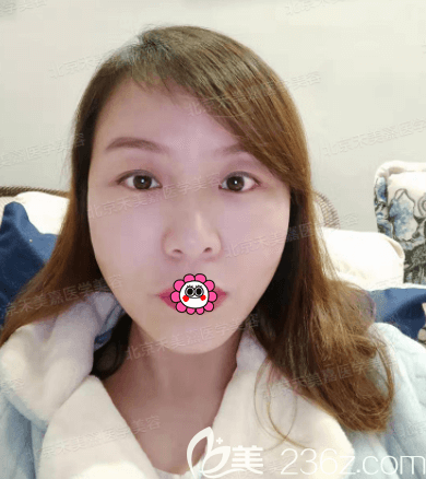 面部脂肪加減法多少錢？我花大幾萬在北京禾美嘉做面部脂肪加減法第32天效果借鑒