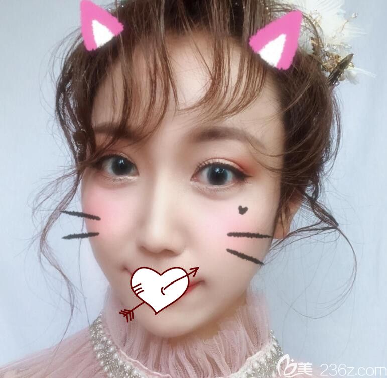 合肥福華整形鼻綜合+埋線術(shù)后第13天恢復(fù)情況