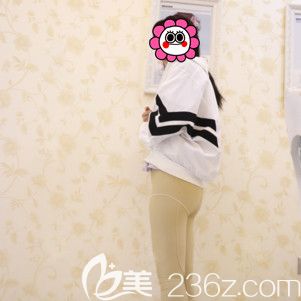 吸脂瘦大腿術(shù)后8天到醫(yī)院復(fù)查 吸脂瘦大腿術(shù)后8天到醫(yī)院復(fù)查