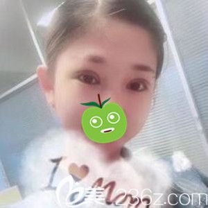 做雙眼皮修復(fù)術(shù)后6天效果圖