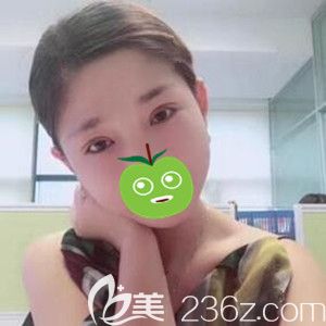 楊慶峰醫(yī)生修復(fù)雙眼皮真人術(shù)后16天照片