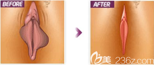 說說我在韓國麗姿做私密整形感受：切除陰蒂包皮、陰蒂會陰除皺、私密美白