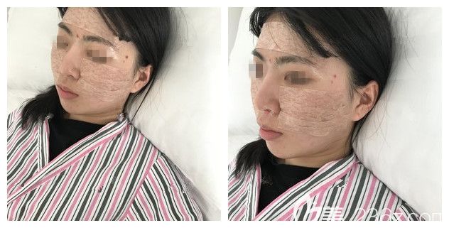 剛做完自體脂肪填充術后即刻效果