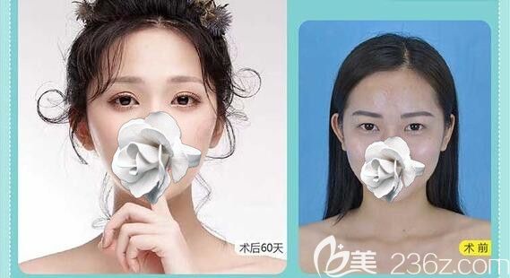 南寧華美整形胡凱全切雙眼皮案例