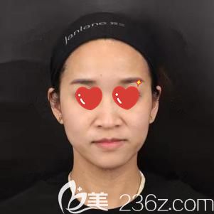 到武漢藝星去法令紋前的自己 到武漢藝星去法令紋前的自己