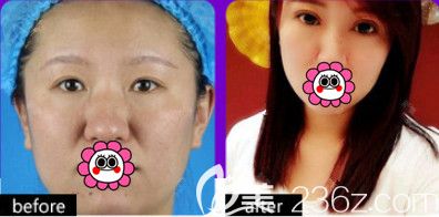 石家莊天伊美雙眼皮案例 石家莊天伊美雙眼皮案例