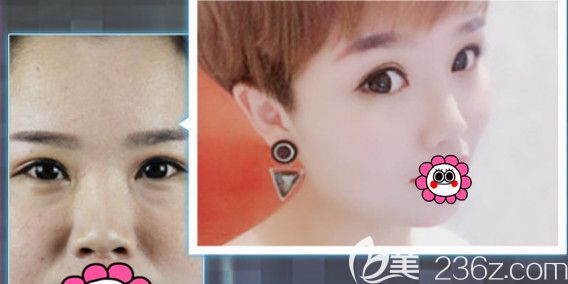 天伊美整形隆鼻手術(shù)案例 天伊美整形隆鼻手術(shù)案例