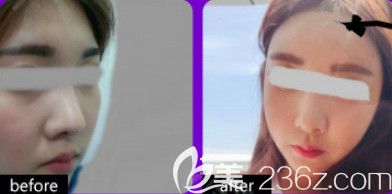 天伊美整形注射除皺案例 天伊美整形注射除皺案例