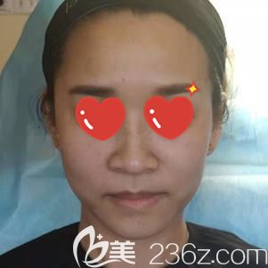 <!--<i data=20240703-sp></i>-->主任幫我做玻尿酸去法令紋術(shù)后即刻消失 <!--<i data=20240703-sp></i>-->主任幫我做玻尿酸去法令紋術(shù)后即刻消失