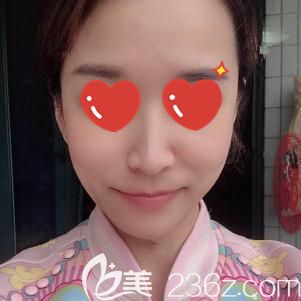 做玻尿酸去法令紋術(shù)后15天臉部變飽滿自然 做玻尿酸去法令紋術(shù)后15天臉部變飽滿自然